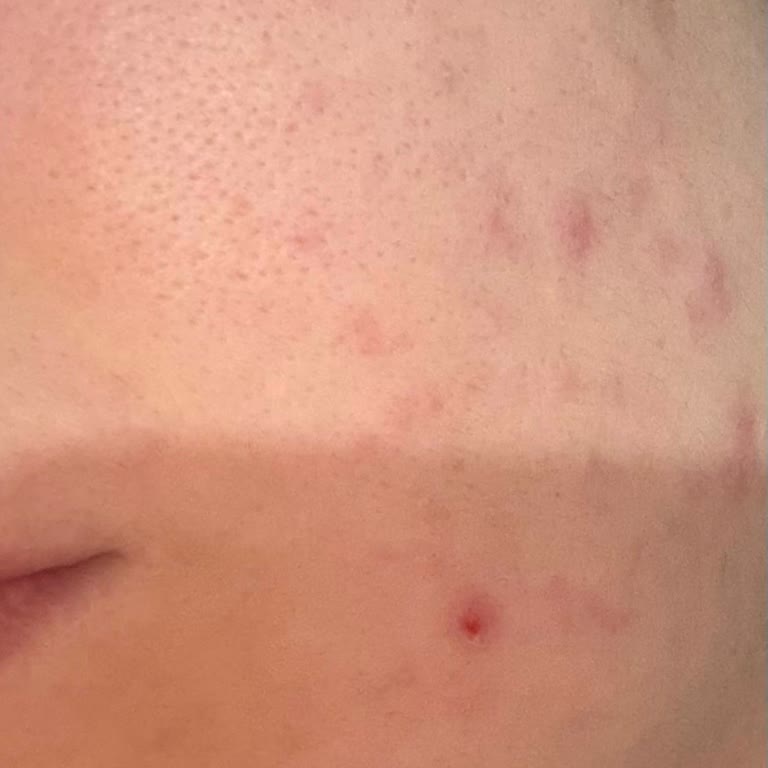 Bioderma Yüz Jeli Kullanımından Şiddetli Kaşıntı Ve Sivilce Patlaması