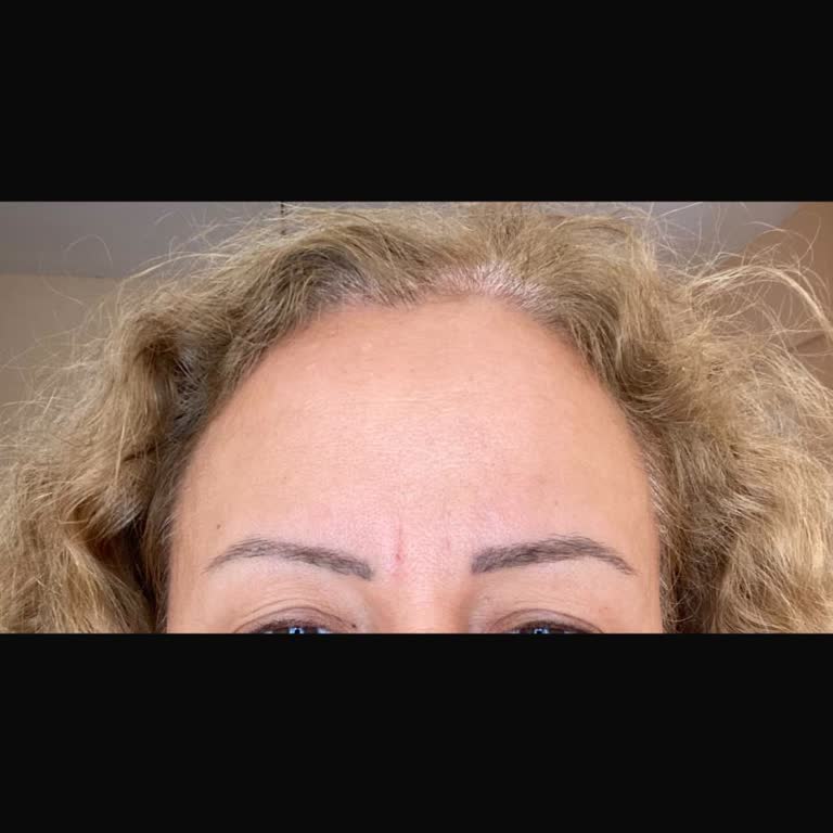Üç Kez Microblading Sonrası Gri Kaş Rengi Devam Ediyor Ve 20.000 TL İadesi Talep Ediliyor