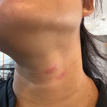 Skin Damage From Nivea Luminous 630