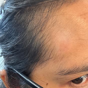 Skin Damage From Nivea Luminous 630