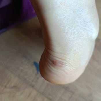 Sağ Ayağımda Yara Oluşturan Ayakkabı İçin İade Ve Değişim Talebimin Reddedilmesi