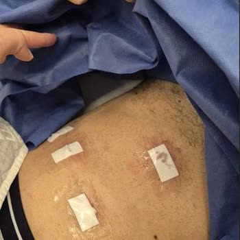 Ameliyat Sonrası Yanlış Dikiş Ve Rapor İhmali Nedeniyle Ücret İadesi Talebi