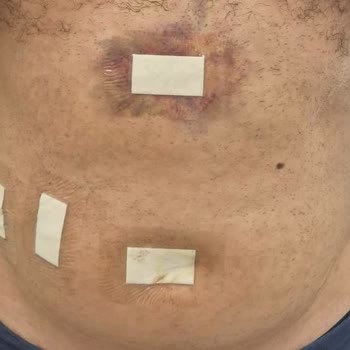 Ameliyat Sonrası Yanlış Dikiş Ve Rapor İhmali Nedeniyle Ücret İadesi Talebi