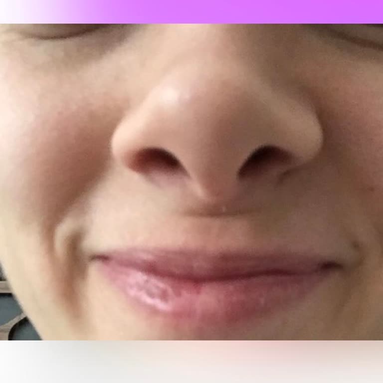 Burun Estetiği Sonrası Deforme Görünüm Ve İade İsteği