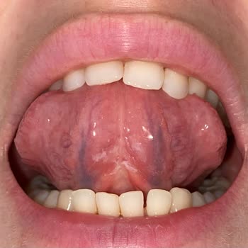 Oral-B Diş Macunu Kullanımından Sonra Dil Altında Şiddetli Aft Ve Ağrı