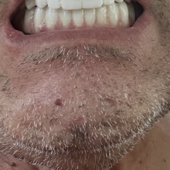 Sanita Sağlık Merkezi'nde Hatalı Implant Ve Zirkonyum Tedavisi Sonrası İade Talebi