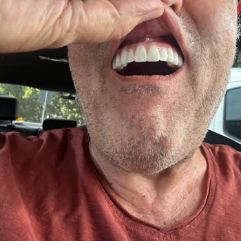 Sanita Sağlık Merkezi'nde Hatalı Implant Ve Zirkonyum Tedavisi Sonrası İade Talebi