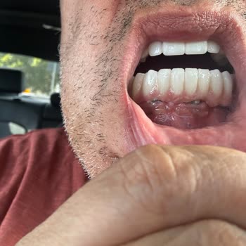 Sanita Sağlık Merkezi'nde Hatalı Implant Ve Zirkonyum Tedavisi Sonrası İade Talebi