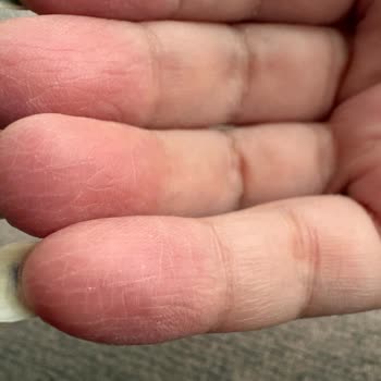 Cif Yeşil Sprey Kullanımında Ellerimde Şiddetli Yanma Ve Tahriş