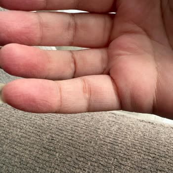 Cif Yeşil Sprey Kullanımında Ellerimde Şiddetli Yanma Ve Tahriş