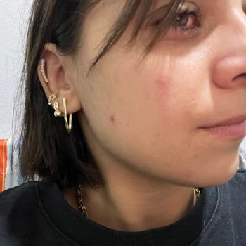Mia Klinika Azelaik Asit Ürünü Ciltte Şiddetli Kızarıklık Ve Yanma Oluşturdu