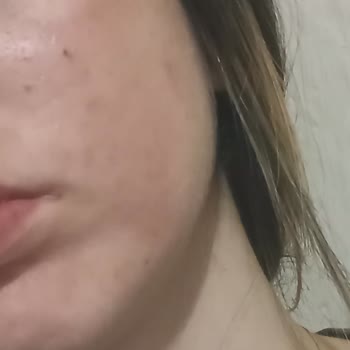 Helba İlaç Munderm Jel Yan Etkisi