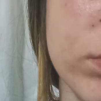 Helba İlaç Munderm Jel Yan Etkisi