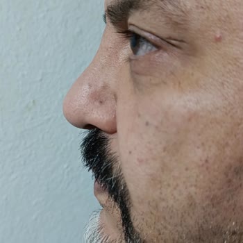 Burun Ameliyatı Sonrası Nefes Alamama Ve Estetik Bozuklukları
