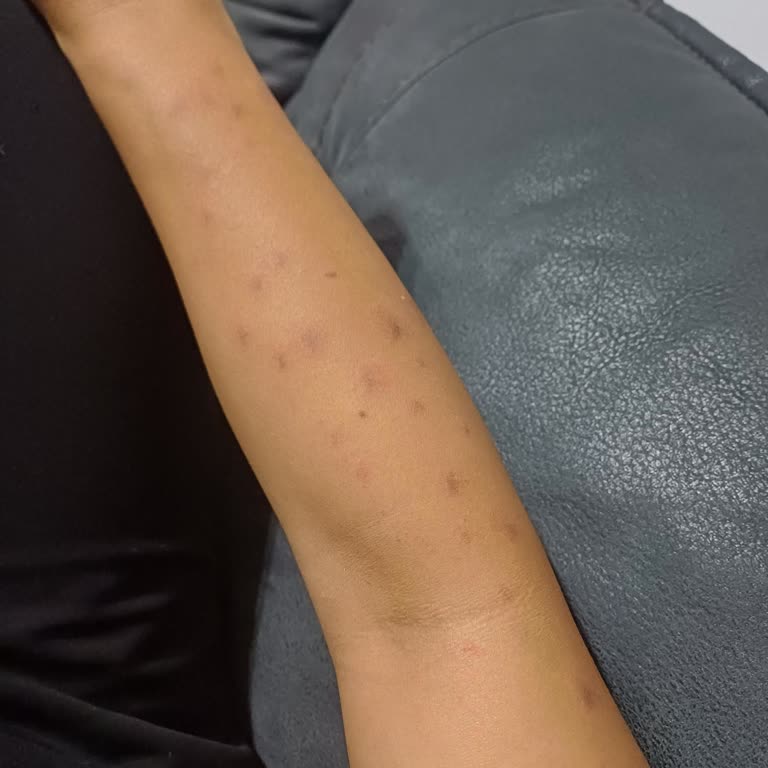 İzmit ELM Lazer Epilasyonunda Yanık İzleri Ve Kalıcı Lekeler İçin Tazminat Talebi