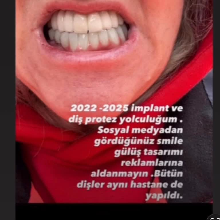 Mosdent Bahçelievler'de Hatalı Protez Ve İmplant Tedavisi Nedeniyle Büyük Mağduriyet
