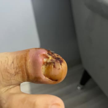 Ayak Parmağı Ameliyatı Sonrası Yara İyileşmemesi Ve Takip Eksikliği