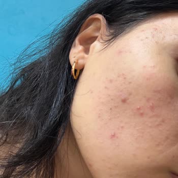 Yves Rocher Yüz Bakım Ürünleri Sonrası Şiddetli Sivilcelenme Ve İade Talebi
