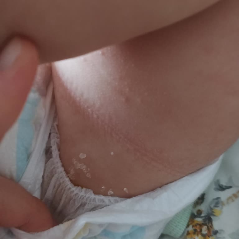 Molfix Bebek Bezinde Emici Taneciklerin Popoya Yapışması: Sağlık Endişesi