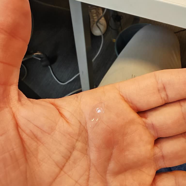 Acuvue Toric Lenslerde Yırtılma Ve Cevapsız Müşteri Desteği