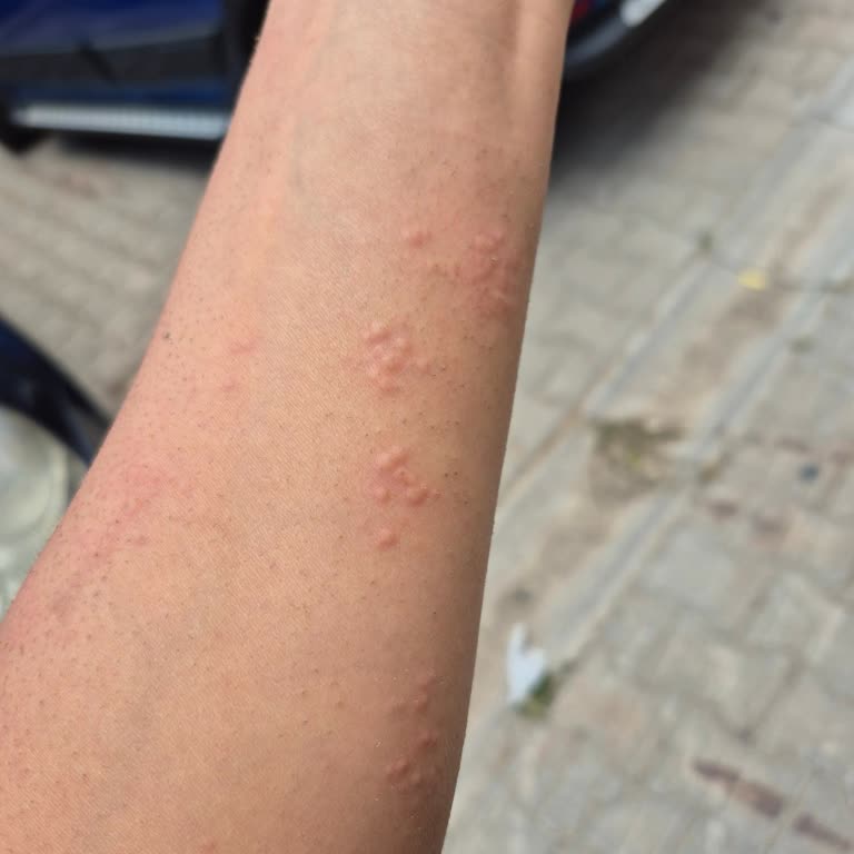 Lazer Epilasyon Sonrası Cilt Kabarcıkları Ve Sağlık Riski