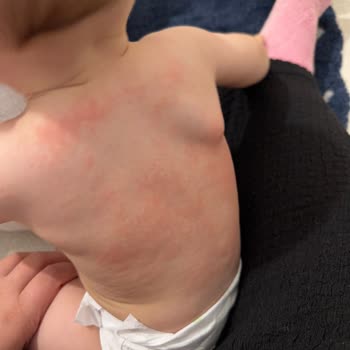 Bebek Kremi Cildinde Şiddetli Alerjik Reaksiyon Ve Güvenlik Talebi