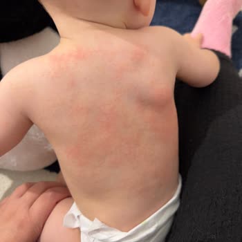 Bebek Kremi Cildinde Şiddetli Alerjik Reaksiyon Ve Güvenlik Talebi