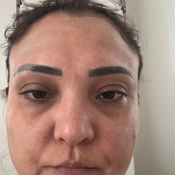 Salisilik Asit Temizleyicisi Cildimde Şiddetli Yanma Ve Lezyonlara Neden Oldu