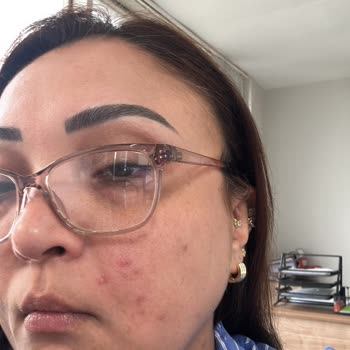 Salisilik Asit Temizleyicisi Cildimde Şiddetli Yanma Ve Lezyonlara Neden Oldu