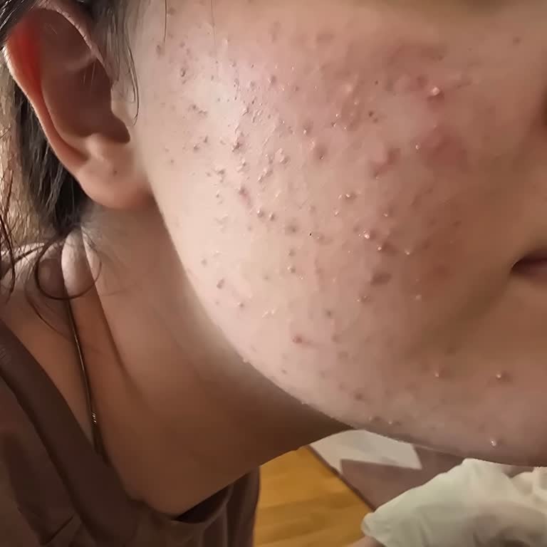 Mia Klinika Anti Acne Solution Sonrası Şiddetli Cilt Reaksiyonu Ve İade Talebi
