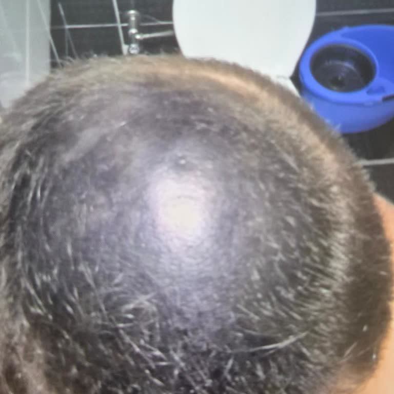 Saç Kapatıcı Ürün Saç Derisini Siyaha Çevirdi Ve İade Reddi