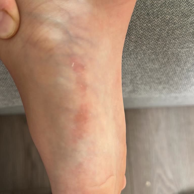 Ayıplı Çocuk Ayakkabısının Yara Ve Kabarcıklara Neden Olması Nedeniyle İade Talebi