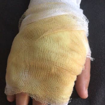 Paslanmaz Çelik Çaydanlıkta Su Sızıntısı Ve Kapağındaki Dengesizlik Yanma Tehlikesi
