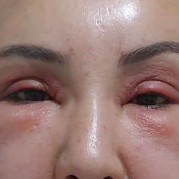 Botoks Uygulaması Sonrası Şişlik Ve Doktor Kimliği Belirsizliği Nedeniyle 7.000 TL İade Talebi