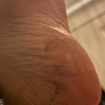 Derimod Botunda Ayak Yaralarına Neden Olması Ve İade Talebi