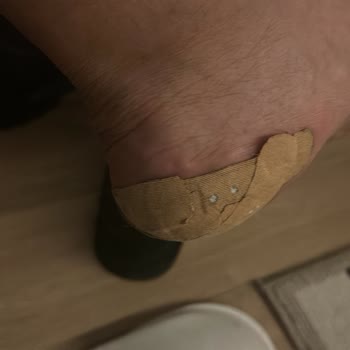Derimod Botunda Ayak Yaralarına Neden Olması Ve İade Talebi