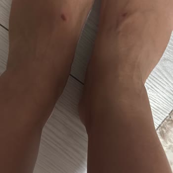 Crocs Platform Terlikte Ayağım Yanık Oldu İade Talebim Cevapsız