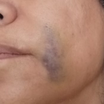 Yanıltıcı Fiyat Teklifi Ve Doktor Yetkinliği Eksikliği Nedeniyle Morarma Sonrası İade Talebi