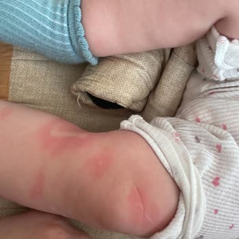Hipp Organik Mama İle Alerjik Reaksiyon Ve Gerekli İade Talebi