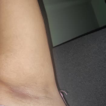 Rexona Clinical Deodorant Kullanımından Şiddetli Kaşıntı Ve Yara Şikayeti