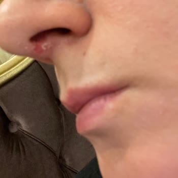 Caudalie Vinopure Yüz Yıkama Jelinde Cilt Kuruluğu Ve Sivilcelenme Şikayeti