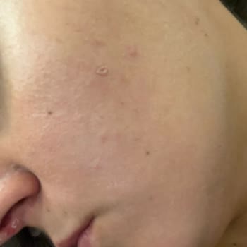 Caudalie Vinopure Yüz Yıkama Jelinde Cilt Kuruluğu Ve Sivilcelenme Şikayeti