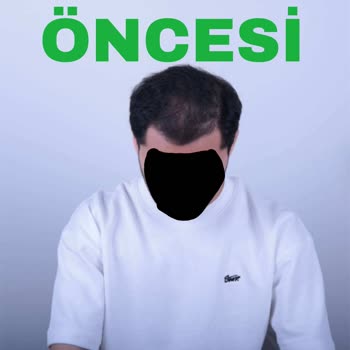 Altunizade Esteworld’da Yanıltıcı Saç PRP Ve Mezoterapi Vaadi Ve 25.000 TL İadesi Talebi