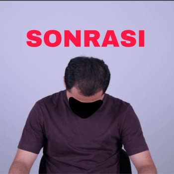 Altunizade Esteworld’da Yanıltıcı Saç PRP Ve Mezoterapi Vaadi Ve 25.000 TL İadesi Talebi