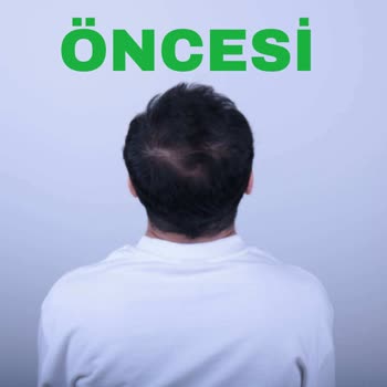 Altunizade Esteworld’da Yanıltıcı Saç PRP Ve Mezoterapi Vaadi Ve 25.000 TL İadesi Talebi
