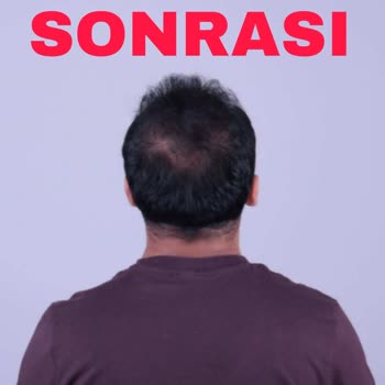 Altunizade Esteworld’da Yanıltıcı Saç PRP Ve Mezoterapi Vaadi Ve 25.000 TL İadesi Talebi