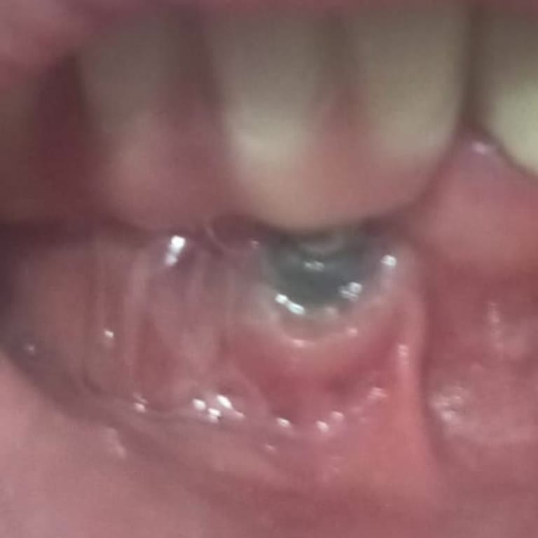 Endokrin Onayı Olmadan Hatalı Implant Uygulaması Ve Zorla Cerrah Ücreti Talebi