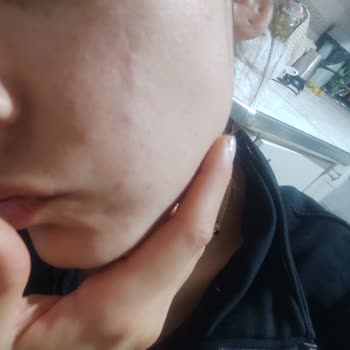 Nivea Yüz Temizleme Jelinde Ani Yanma Ve Kızarıklık Şikayeti