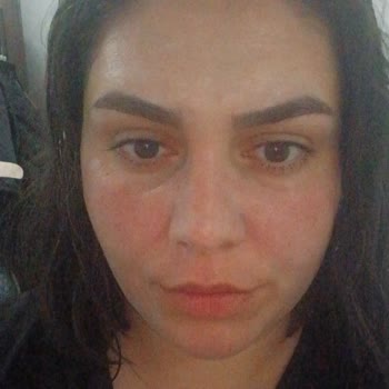 Garnier Maske Kullanımında Şiddetli Yanma Ve Kızarıklık