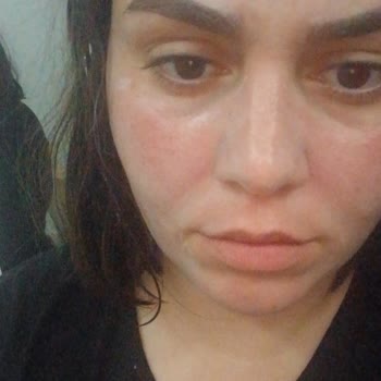 Garnier Maske Kullanımında Şiddetli Yanma Ve Kızarıklık